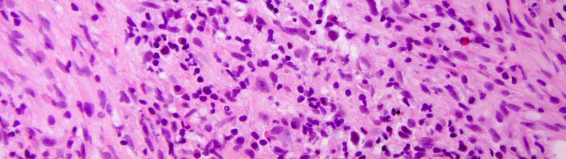 Chłoniaki - wiadomości ogólne | Hematoonkologia.pl