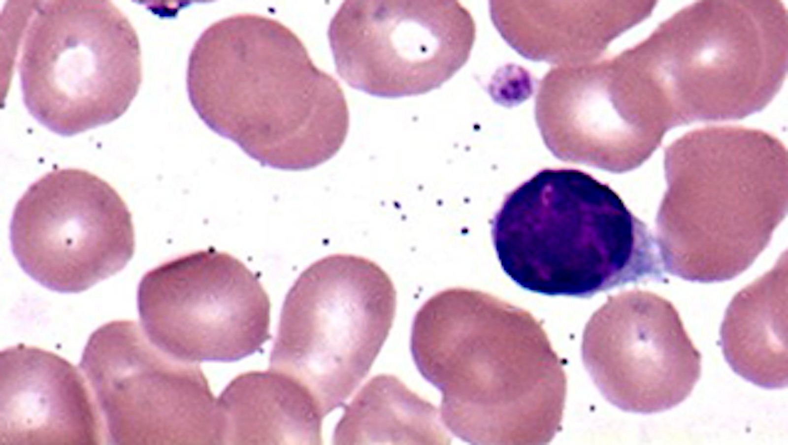 Akalabrutynib w skojarzeniu z obinutuzumabem i wenetoklaksem w leczeniu 1. linii...