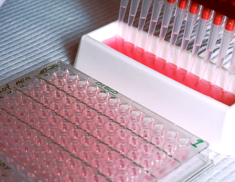 Idiopatyczna nabyta hemofilia A z niewykrywalnym inhibitorem do czynnika VIII