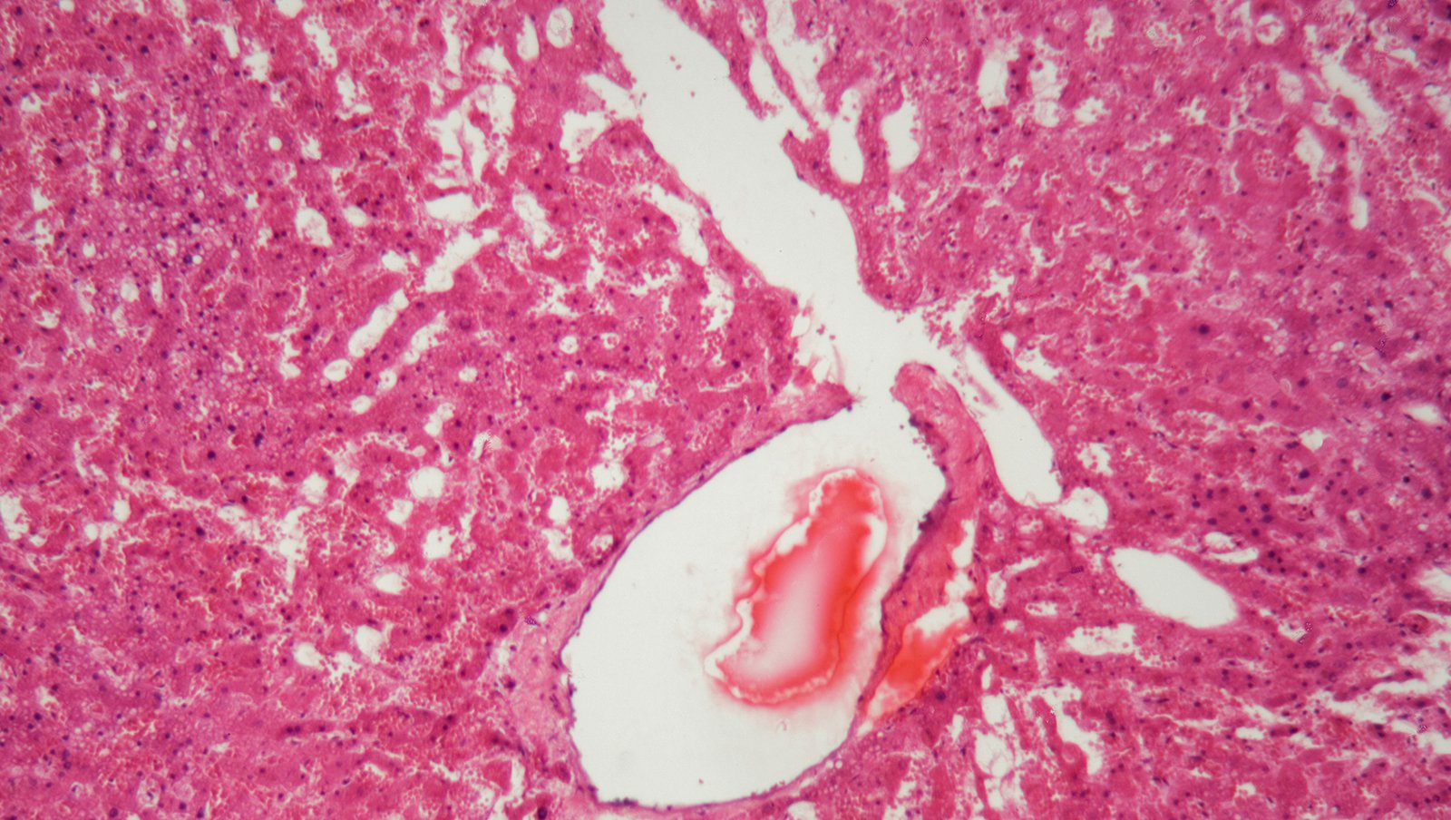 Bortezomib, melfalan i deksametazon w leczeniu amyloidozy łańcuchów lekkich
