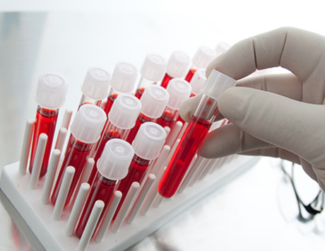Wytyczne postępowania w hemofilii World Federation of Haemophilia 2013 – co nowego?...