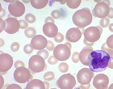 Leczenie podtrzymujące rytuksymabem po immunochemioterapii indukcyjnej u chorych na chłoniaka z komórek płaszcza: wyniki długookresowej obserwacji badania z Wisconsin Oncology Network