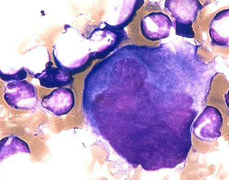 Rytuksymab w leczeniu ITP u chorych z zachowaną śledzioną – randomizowane badanie...