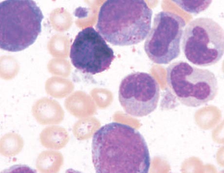 Ciężka neutropenia jest niekorzystnym czynnikiem prognostycznym u chorych na zespoły mielodysplastyczne niskiego ryzyka