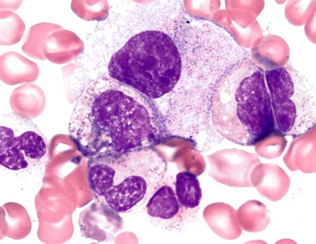 Zespół „MonoMAC„ i MDS