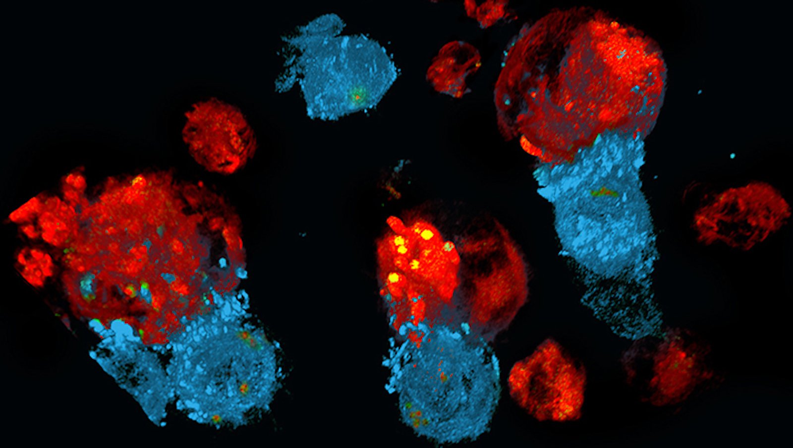 Chłoniak rozlany z dużych komórek B (DLBCL) – co należy o nim wiedzieć?