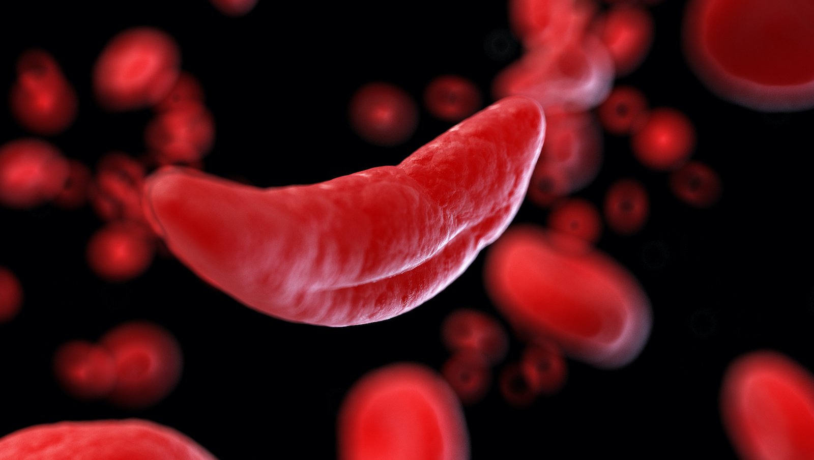 FDA przyjęła do oceny priorytetowej wniosek uzupełniający o zatwierdzenie nowego leku Oxbryta® (voxelotor) w leczeniu niedokrwistości sierpowatokrwinkowej u dzieci w wieku od 4 do 11 lat