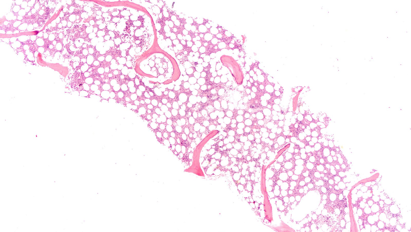 Gdy szpik kostny włóknieje | Prof. dr hab. n. med. Joanna Góra-Tybor