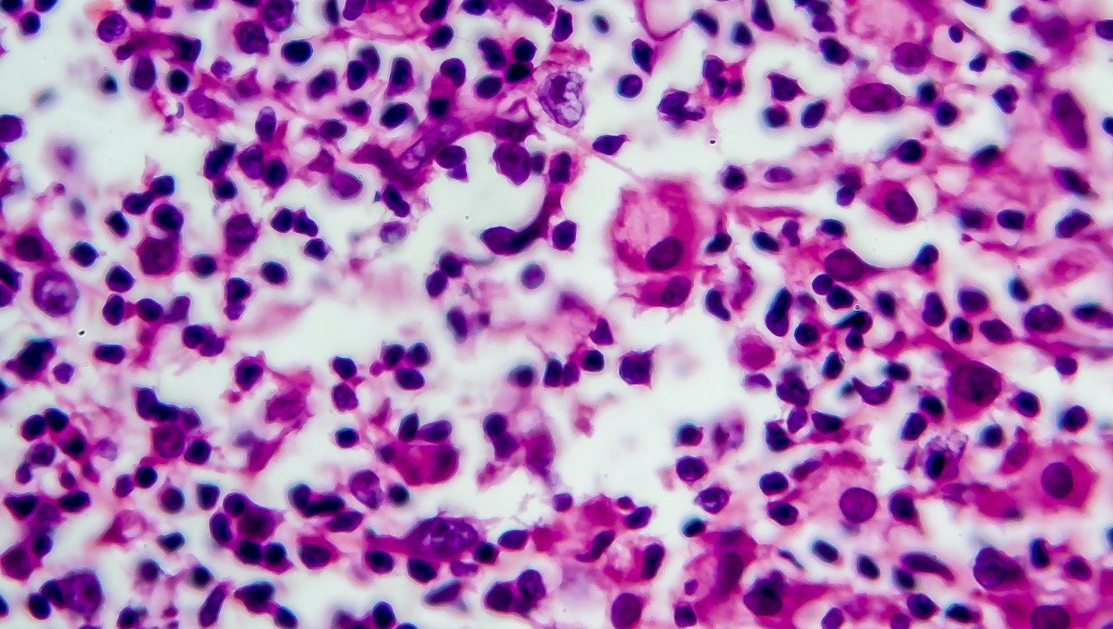 Pembrolizumab w porównaniu z brentuksymabem w nawrotowym lub opornym chłoniaku Hodgkina – wyniki wstępne badania KEYNOTE-204