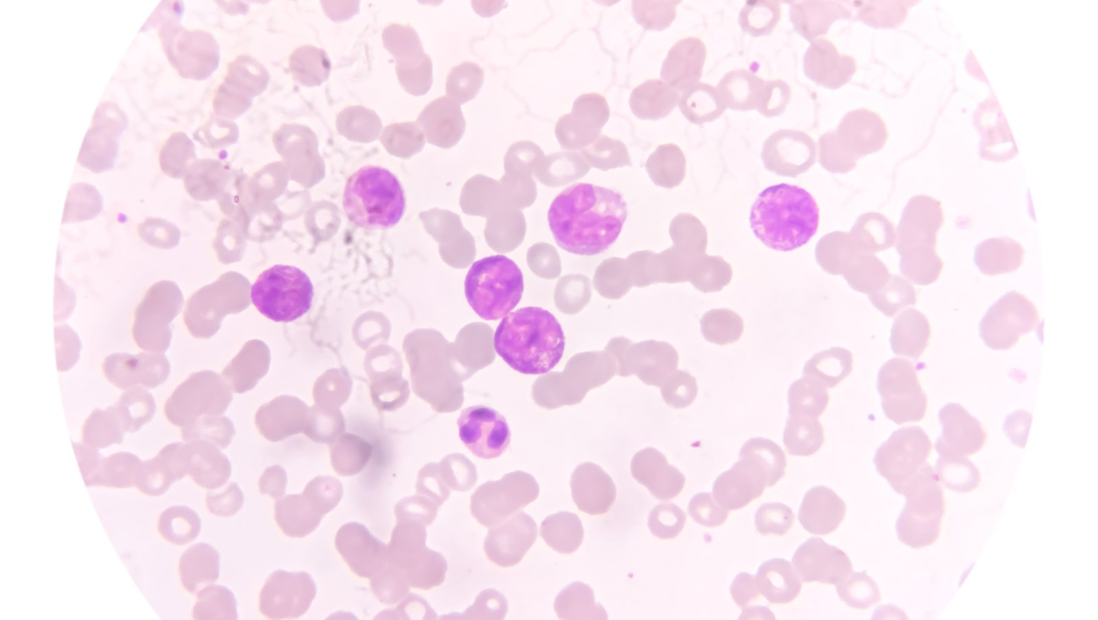 Leczenie ostrej białaczki szpikowej wysokiego ryzyka (t-AML, AML-MRC) w praktyce...