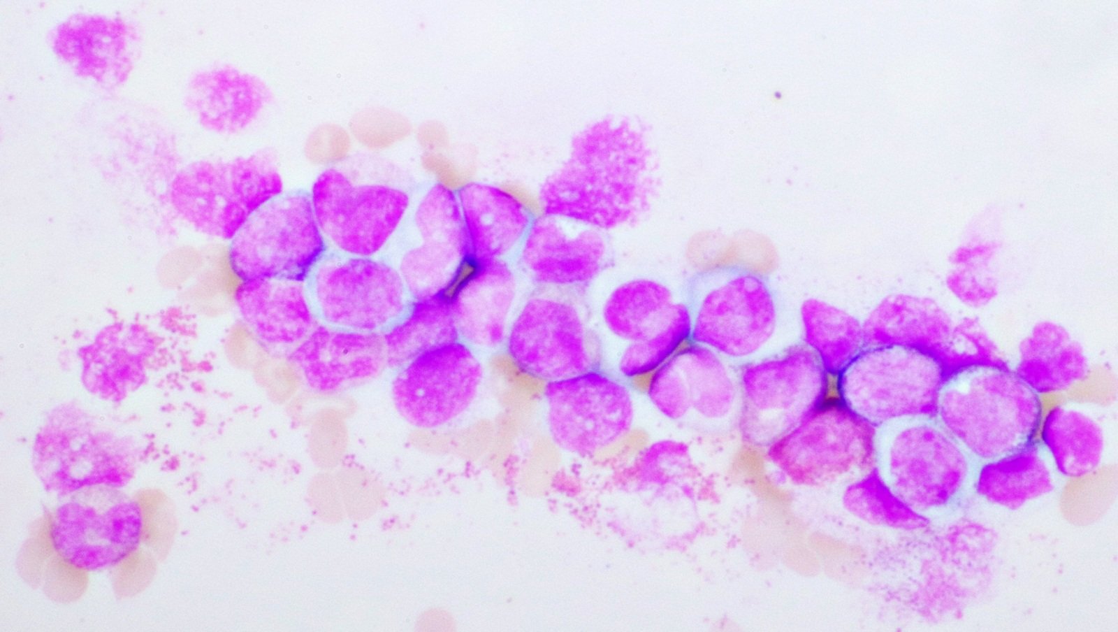 Analiza długoterminowego przeżycia w dużej kohorcie pacjentów z ostrą białaczką...