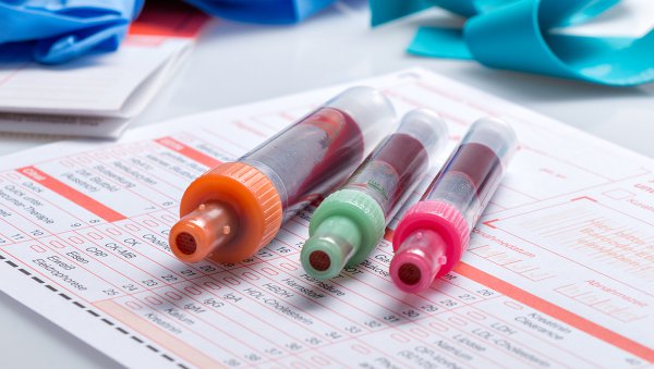 Badania laboratoryjne w diagnostyce małopłytkowości indukowanej heparyną