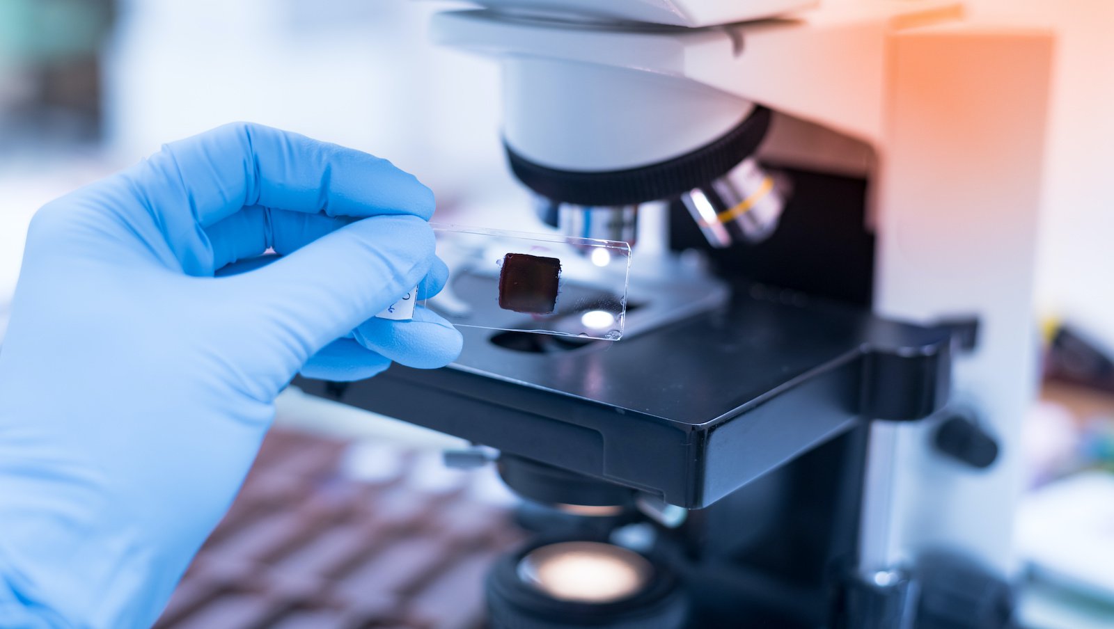 Inhibitory immunologicznych punktów kontroli w leczeniu ratunkowym koinfekcji aspergilozy...