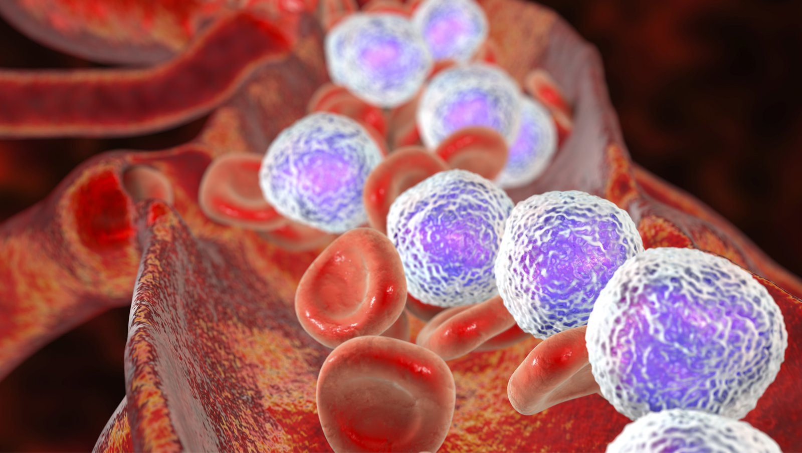 Skuteczność wenetoklaksu u pacjentów z zespołami mielodysplastycznymi