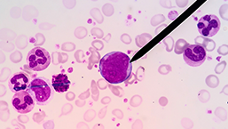 Blinatumomab w terapii opornego/nawrotowego DLBCL – wyniki badania II fazy