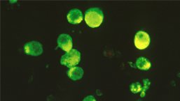 Busulfan Melphalan i Bortezomib w porównaniu do wysokich dawek Melphalanu jako leczenia kondycjonującego przed autologiczną transplantacją macierzystych komórek krwiotwórczych w szpiczaku plazmocytowym