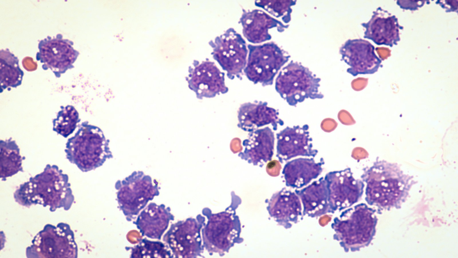 DLBCL – najczęstszy chłoniak nieziarniczy