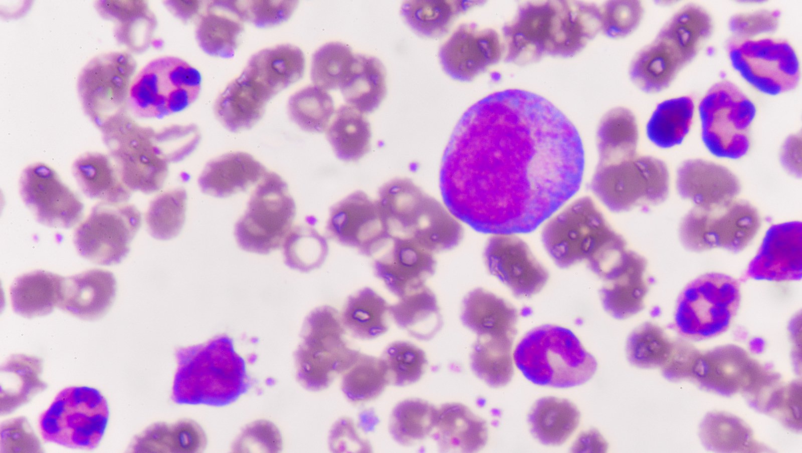 Skuteczność inhibitorów kinazy Brutona po niepowodzeniu leczenia wenetoklaksem