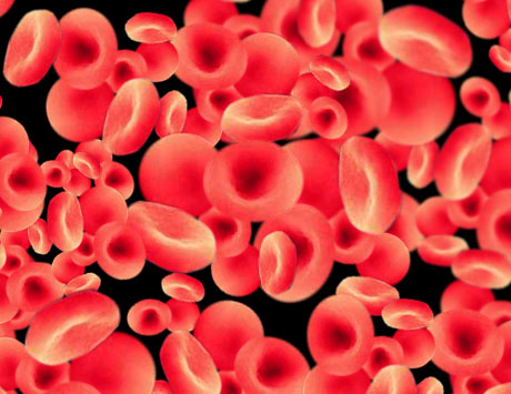 Pacjent z nabytą hemofilią A indukowaną clopidogrelem