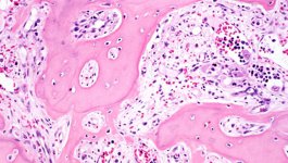 Co nowego w przewlekłych nowotworach mieloproliferacyjnych Ph ujemnych? - EHA 2014