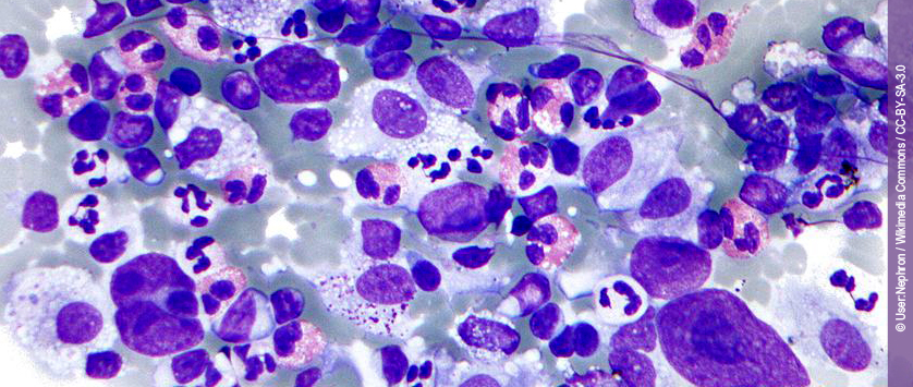 Czy Brentuximab Vedotin zapoczątkował przełom w leczeniu opornych i nawrotowych postaci Chłoniaka Hodgkina?