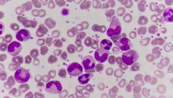 Czy wszyscy chorzy na ostrą białaczkę limfoblastyczną Ph(+) wymagają przeszczepienia allogenicznego krwiotwórczych komórek macierzystych?