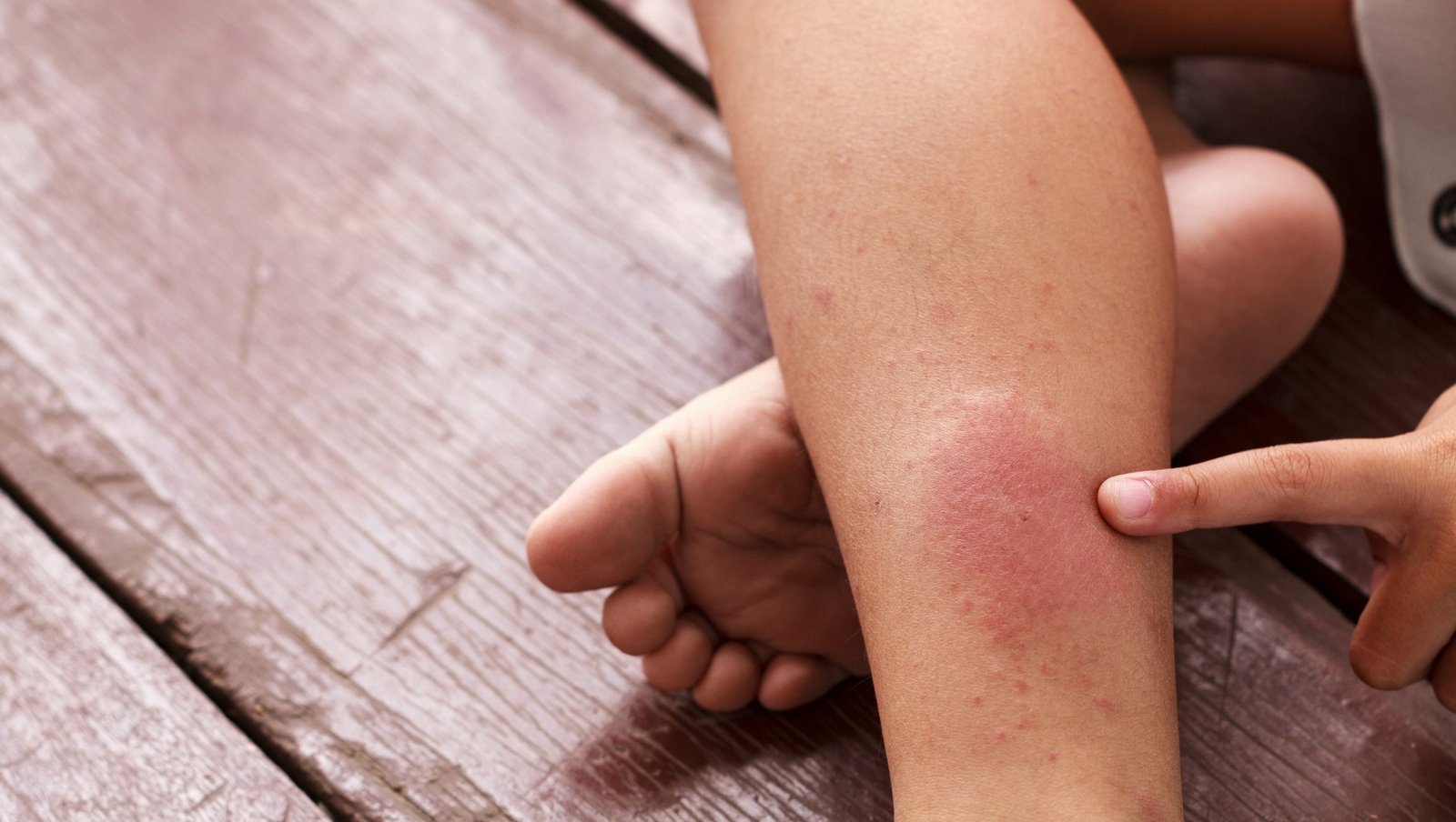 Dabigatran w leczeniu i wtórnej profilaktyce zakrzepicy żylnej u dzieci z trombofilią