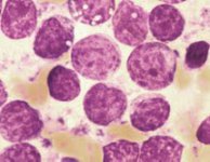 Doświadczenia lekarzy z MD Anderson Cancer Center z chłoniakami „double hit”