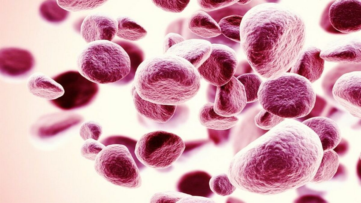 Ultrarzadka nocna napadowa hemoglobinuria
