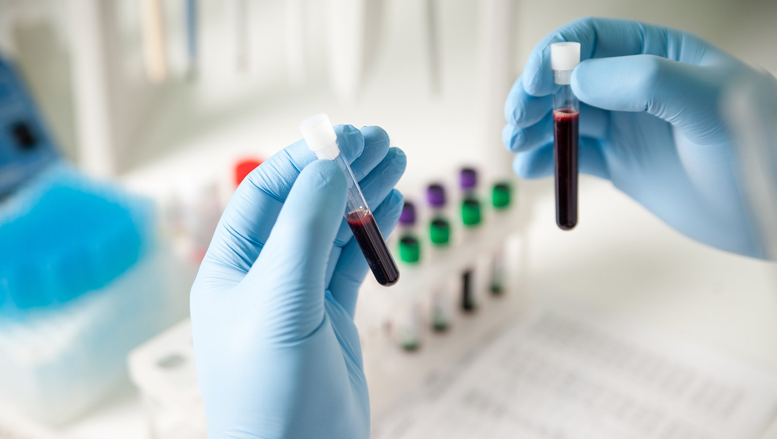 Choroba Gauchera – każdy hematolog może ją rozpoznać