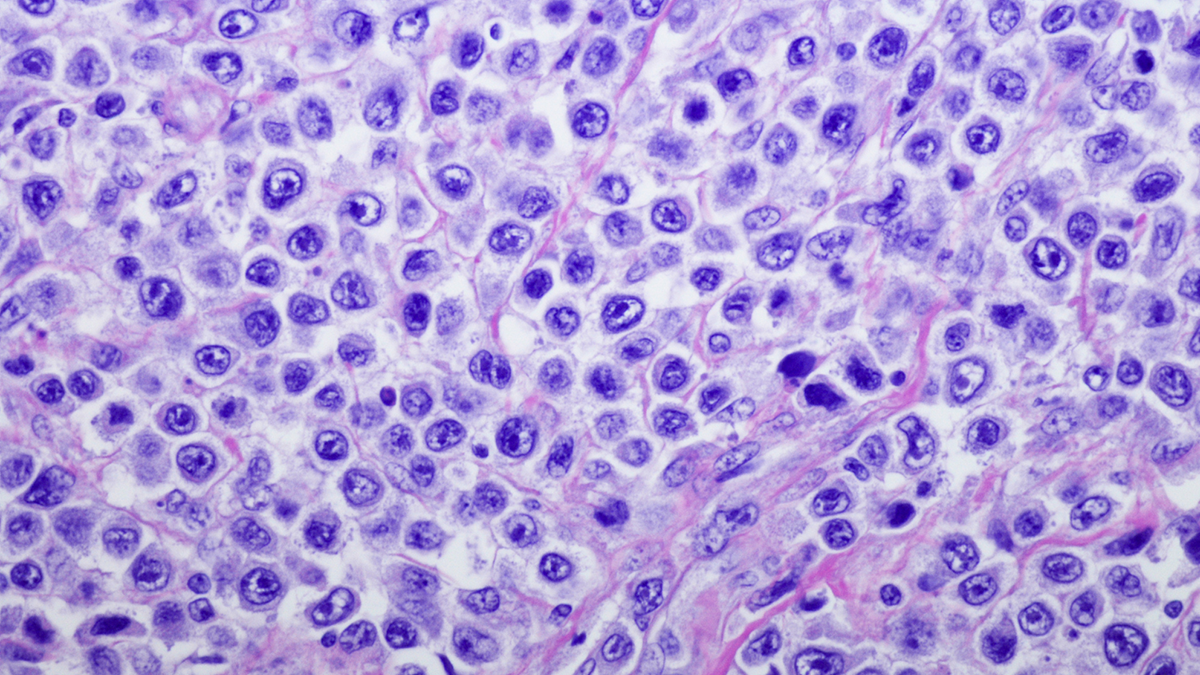 Glofitamab skuteczną terapią w nawrotowym chłoniaku rozlanym z dużych komórek B, także po terapii CAR-T