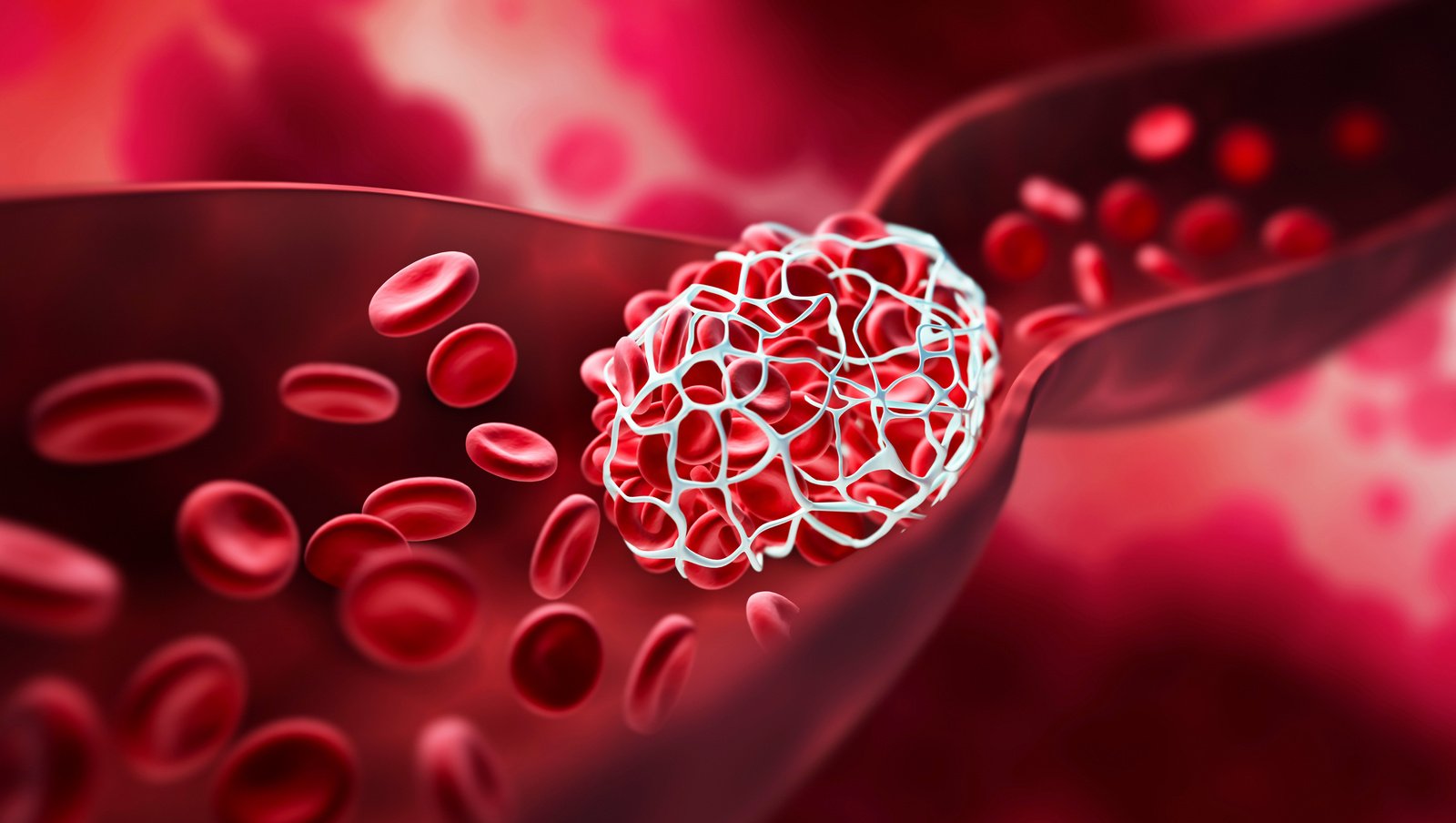 Brak odpowiedzi na leczenie u pacjentów z nocną napadową hemoglobinurią – komentarz...