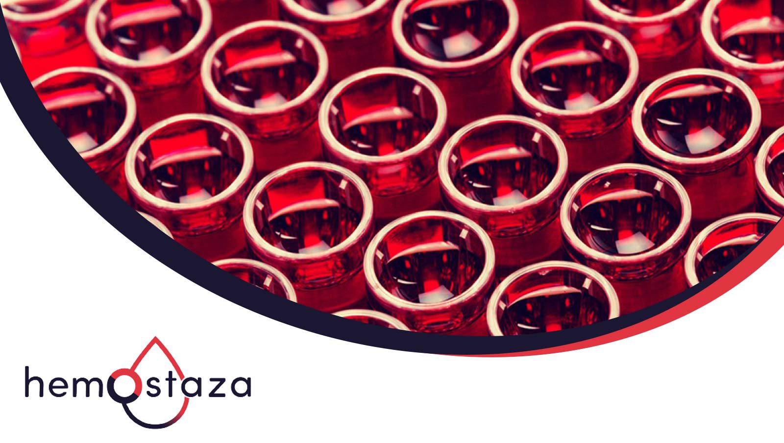 Wpływ antykoagulantu toczniowego na pozytywny wynik inhibitora u pacjentów z wrodzoną...