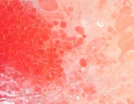 Infekcje u chorych na SzP – badanie szwedzkiej populacji