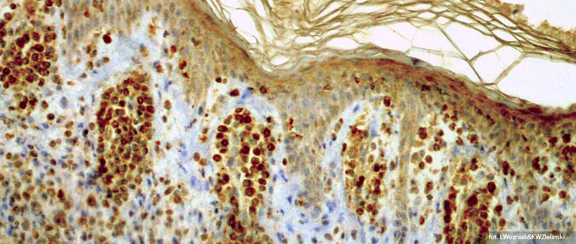 Kinaza Blk celem terapeutycznym dla chłoniaka skórnego z komórek T?