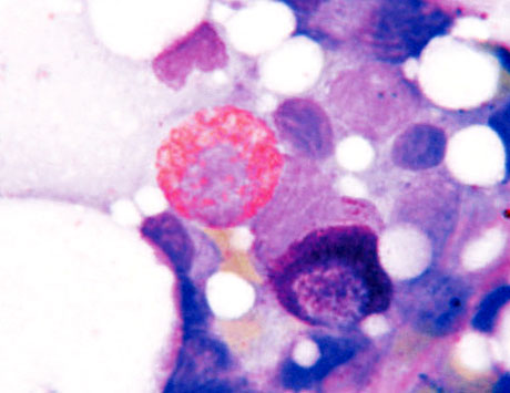 Nowy  indeks prognostyczny dla chorych z przewlekłą białaczką mielomonocytową (CMML) -  CPSS (CMML- specific  prognostic  scoring system)