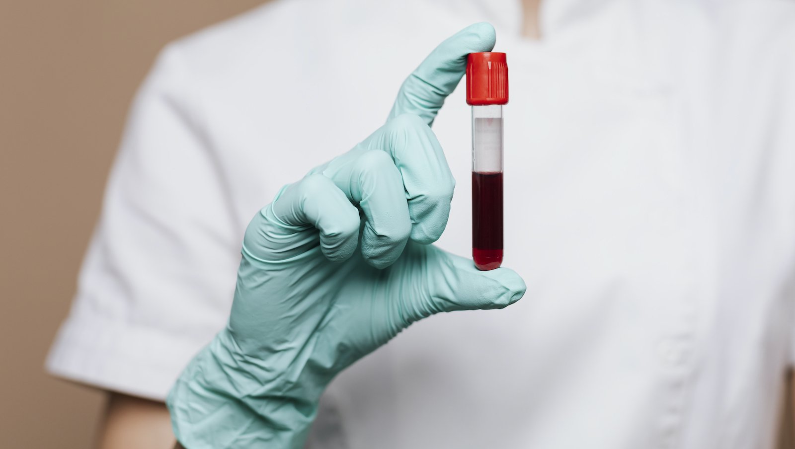 Przewlekła białaczka limfocytowa – obraz nowotworu krwi