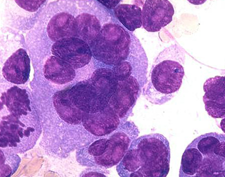 Lenalidomid w leczeniu chorych na szpiczaka z niewydolnością nerek