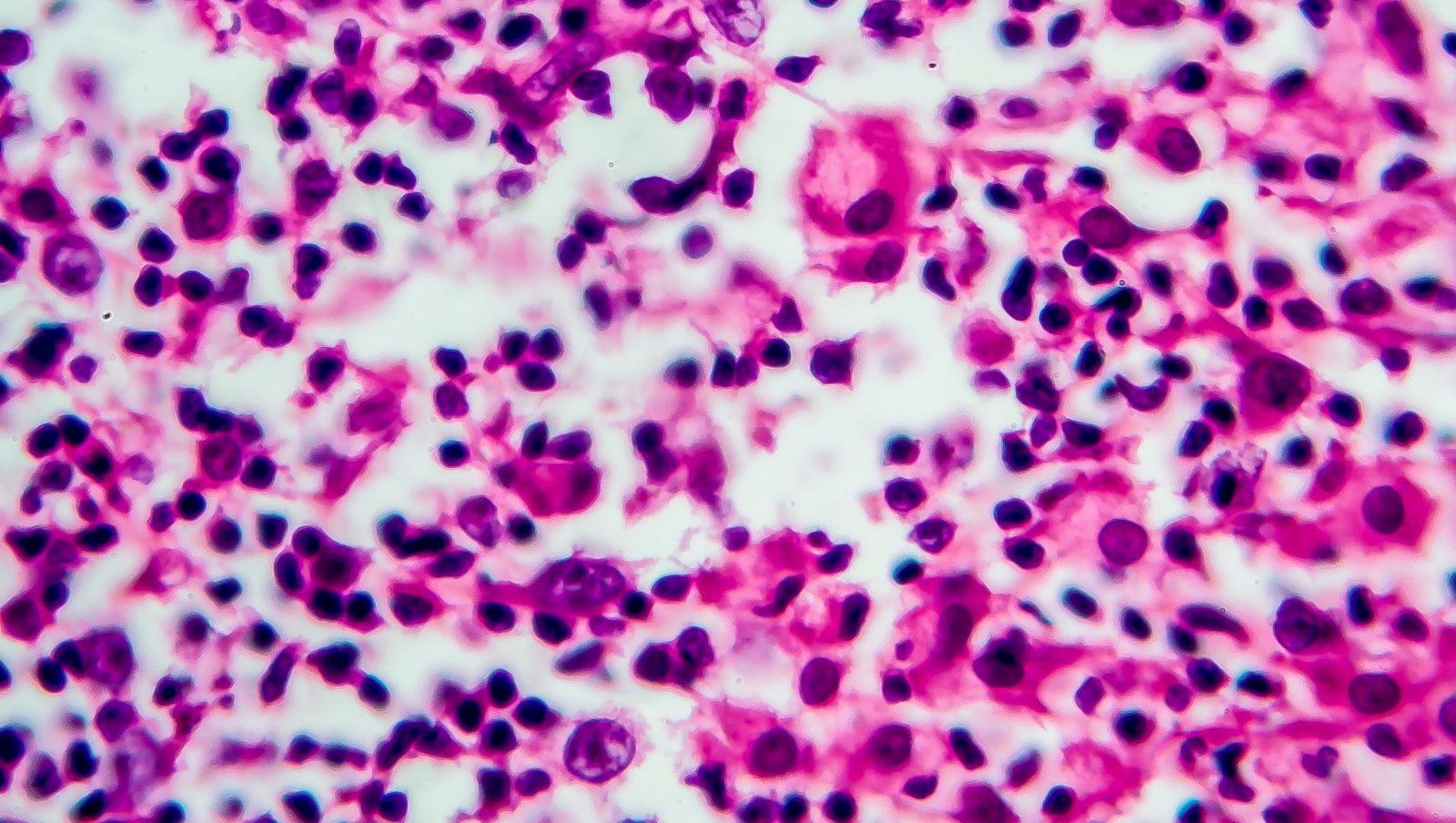 Brentuksymab vedotin – konsolidacja po autologicznym przeszczepieniu komórek macierzystych u pacjentów z chłoniakiem Hodgkina, u których występuje zwiększone ryzyko nawrotu lub progresji choroby. Podsumowanie doświadczeń z praktyki klinicznej w różnych krajach