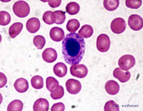 Małopłytkowość immunologiczna (ITP) – chirurgiczne czy farmakologiczne leczenie...