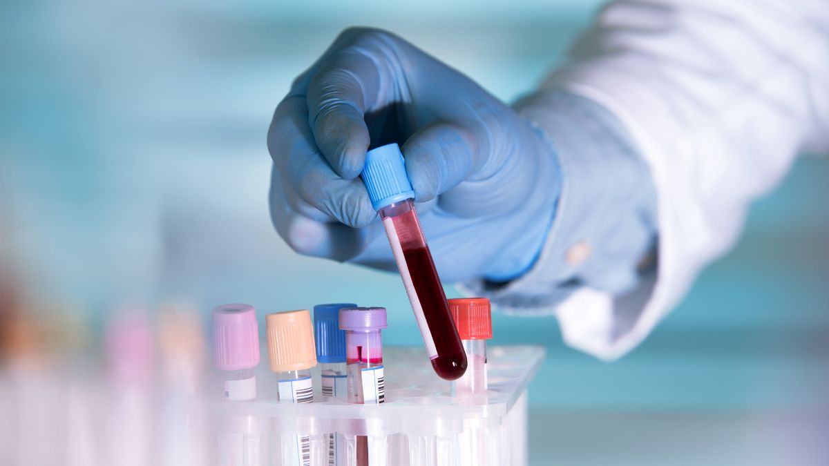 Polskie zalecenia postępowania w pierwotnej małopłytkowości immunologicznej u dorosłych...