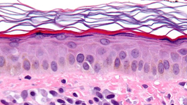 Mastocytoza – trudna do wykrycia choroba nowotworowa