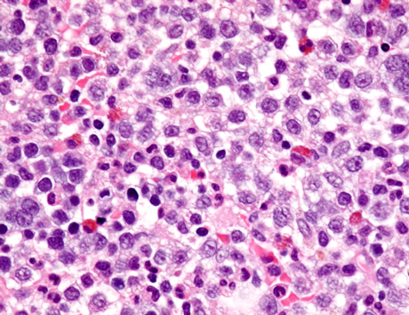 Diagnostyka i leczenie chorych na zespoły mielodysplastyczne w Niemczech