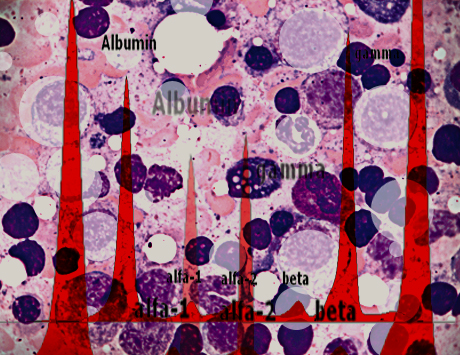 Gammapatia monoklonalna o nieokreślonym znaczeniu i szpiczak plazmocytowy: epidemiologia,...