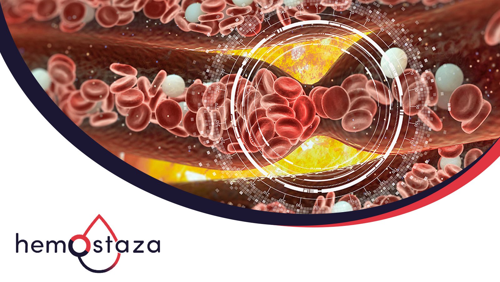 Zapalenie naczyń związane z IgA (Plamica Schönleina i Henocha) u dorosłych