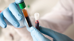 Nacieki skóry w przebiegu szpiczaka plazmocytowego (MM) - wieloośrodkowe, retrospektywne...