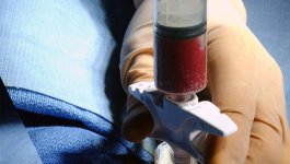 Napromienianie całego ciała czy busulfan w kondycjonowaniu przed przeszczepieniem komórek krwiotwórczych u dzieci?