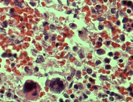 Cytotoksyczne działanie ibrutinibu (inhibitora BTK) na komórki szpiczaka plazmocytowego