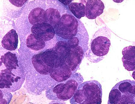 Nowe możliwości terapii chorych na szpiczaka z opornością na bortezomib i leki immunomodulujące