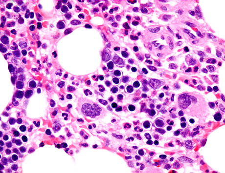 VTD bez bisfosfonianów w terapii konsolidującej chorych na szpiczaka plazmocytowego...
